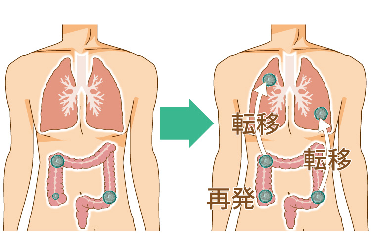 なぜ「再発」するのか