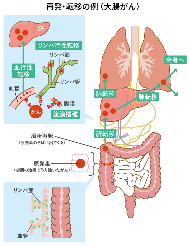 再発・転移の分類